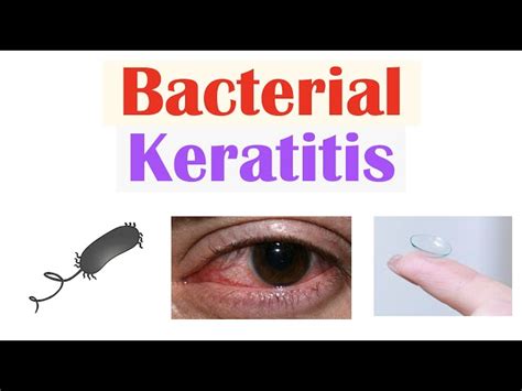 Bacterial Keratitis Symptoms