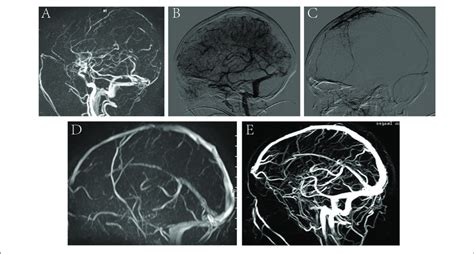 A Representative Image Of A Severe CVST Before And After