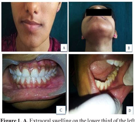 Multicystic Ameloblastoma