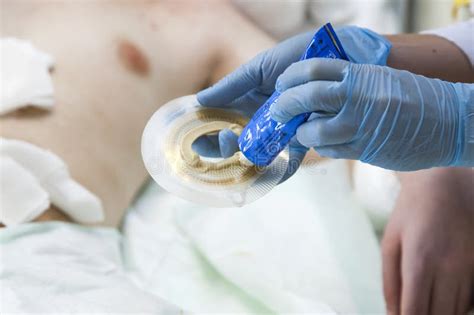 Colostomy Care Procedure