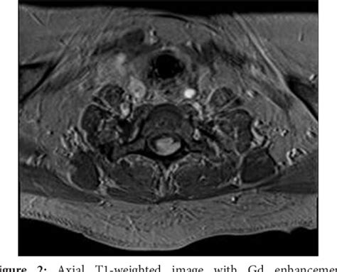 Figure 1 From Intramedullary Hemangioblastoma Of The Thoracic Cord With