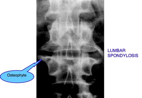 Rhodas Ct Mri Procedures Lumbar Spondylosis