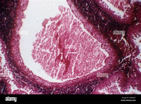 Salivary Gland Tumour Light Micrograph Of A Section Through A Warthin