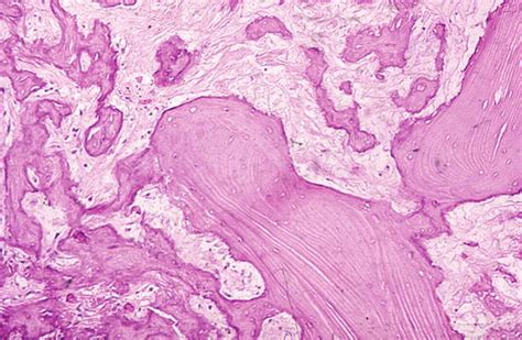 Telangiectatic Osteosarcoma | Musculoskeletal Key