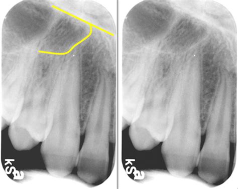 Floor Of Nasal Cavity Radiograph Viewfloor Co