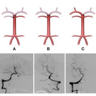figure   basilar top occlusion type  classified