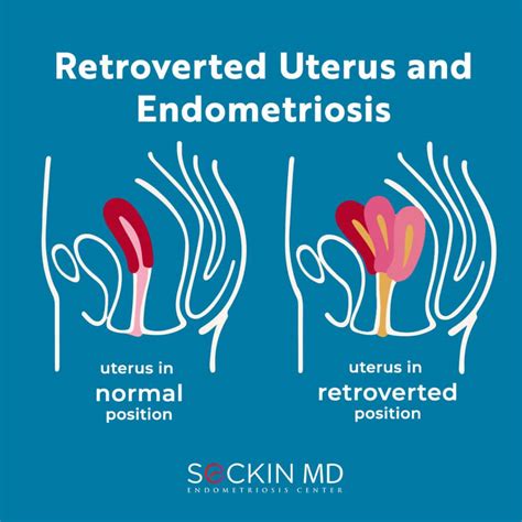 Retroverted Or Tilted Uterus And Endometriosis