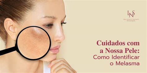 Cuidados A Nossa Pele Como Identificar O Melasma