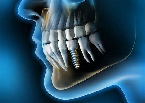 Odontologia Digital Escaner Intraoral