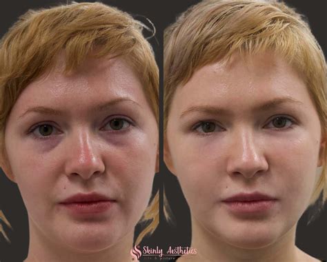 Under Eye Fillers Before After Results At Skinly