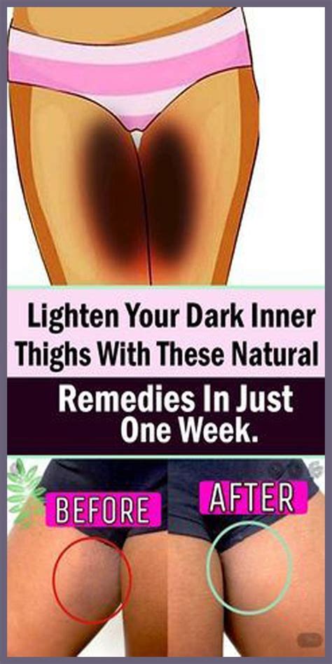 4 Natural Home Remedies To Lighten Your Dark Inner Thighs Skin Lightening Diy Lighten Inner