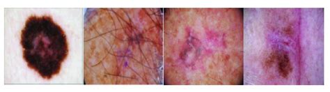 The skin lesion diagnosis of malignant | Download Scientific Diagram