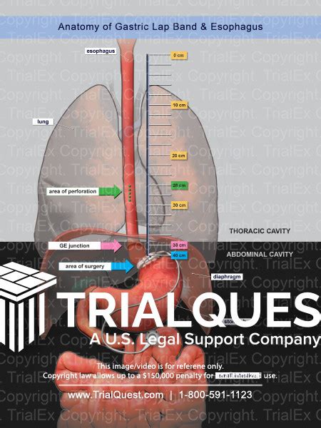 Anatomy Of Gastric Lap Band And Esophagus Trialquest Inc