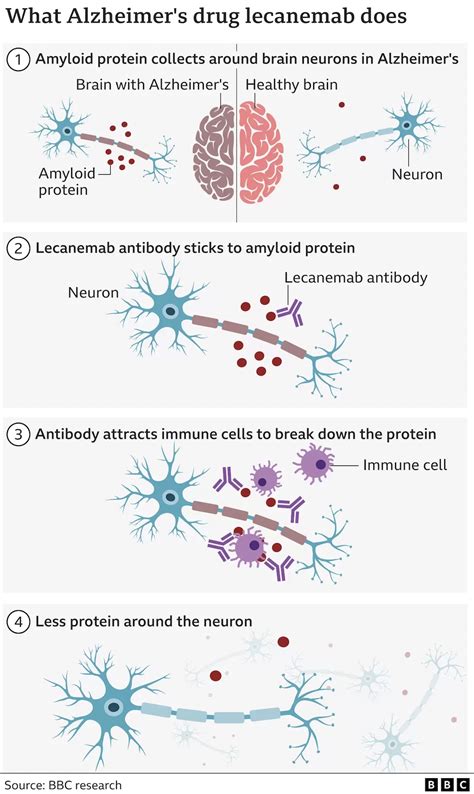 New drug 'Lecanemab' slows the effects of Alzheimer's disease