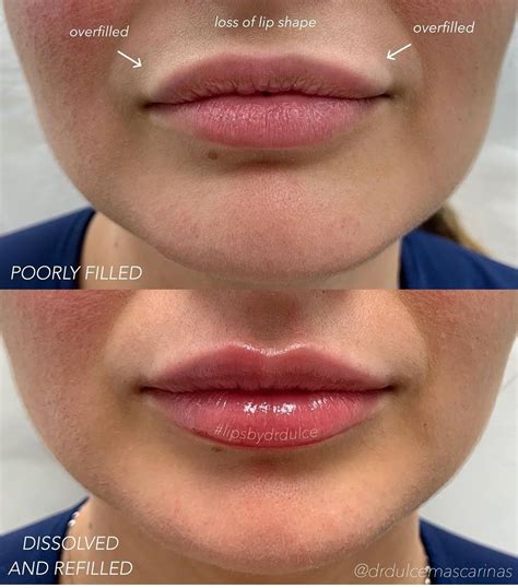 Lip Fillers Near Me Afterpay Macie Fay