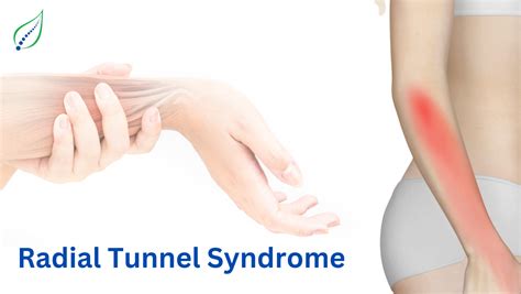 Radial Tunnel Syndrome: Symptoms, Causes, and Treatments | Best Back ...