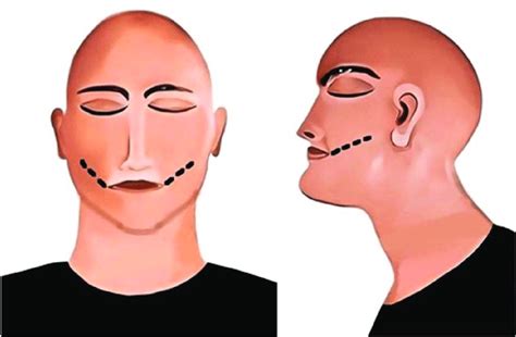 Extraoral incision method; black line represents the incision. A ...