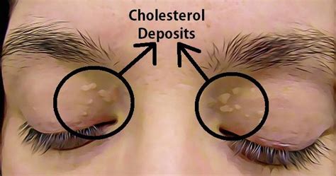 How To Remove The Cholesterol Deposits Around Your Eyes Aimdelicious