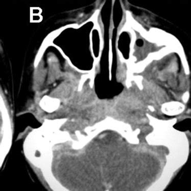 Paralytic midriasis in both eyes and superior temporal left eye ...