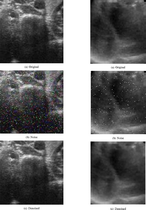 Figure From Medical Ultrasound Image Speckle Noise Reduction By