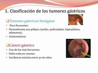 Ppt general cancer gástrico PPT