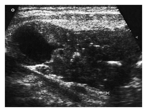 Ultrasound finding of parathyroid carcinoma (longitudinal)—a tumor with ...