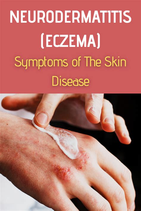 Neurodermatitis Eczema Symptoms Of The Skin Disease Artofit