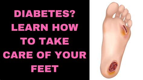 Diabetic Foot 7 Diabetic Foot Care Tips Youtube