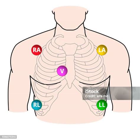 5 Lead Electrode Placement Electrocardiogram Ra La Rl Ll V Position Of