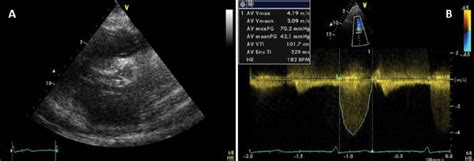 Transthoracic Echocardiography A Parasternal Short Axis View Shows