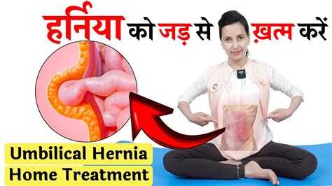 हर्निया को जड़ से ख़त्म करें Umbilical Hernia Home Treatment Only 3 Simple Yoga Pose For