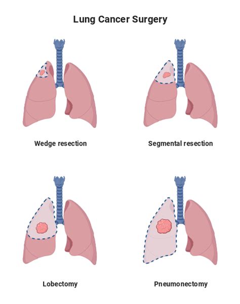 Lung Cancer Surgery without Description (Vertical) | BioRender Science Templates