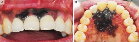 Intraoral Malignant Melanoma Medizzy