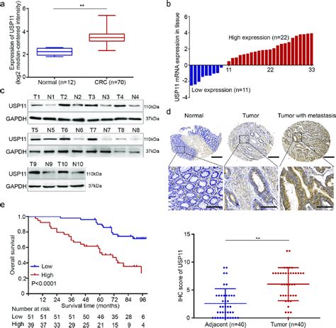 Expression Of Usp11 In Crc And Its Clinical Significance A Usp11