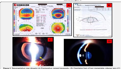 Management of Compound Myopic Astigmatism Using Toric Implantable ...