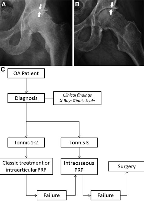 Intraosseous Infiltration Of Platelet Rich Plasma For Severe Hip