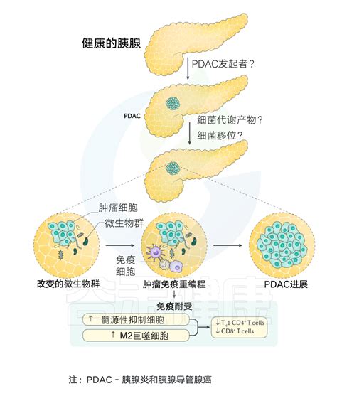 胰腺导管腺癌 谷禾健康