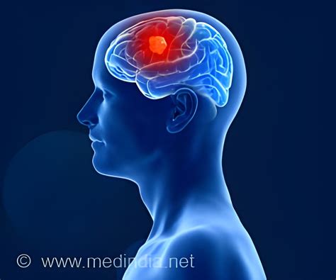 Brain Tumor Symptoms Often Mimic Mental Illness