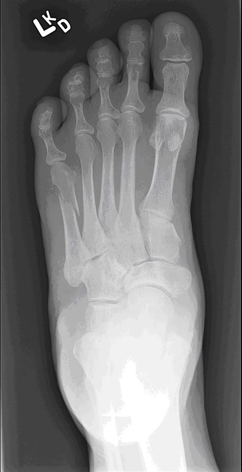 Distal Metatarsal Fracture