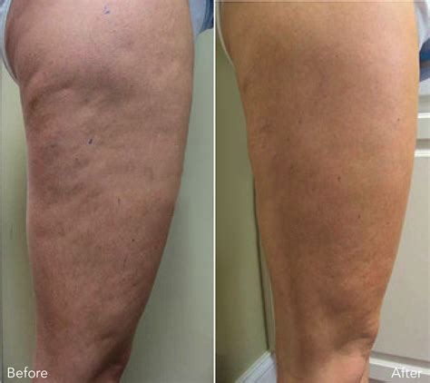 Cellulite Laser Treatment All The Truth Pros And Cons Results Heliotherapy Research Institute