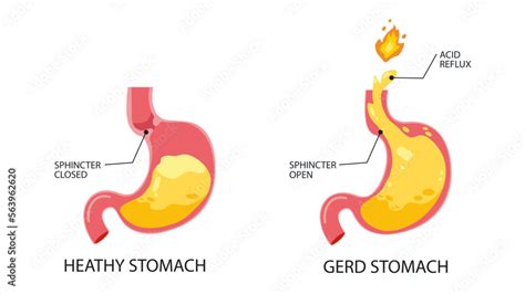 Gastroesophageal Reflux Disease Infographic Of Normal Healthy Stomach