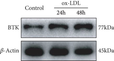 Btk Knockdown Suppressed The Inflammatory Responses Of Ox Ldl Induced