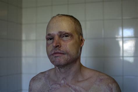 Photographing The Scars From Near Death Experiences – British Journal ...