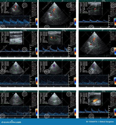 Echo cardiogram stock photo. Image of pancreas, illness - 15566976