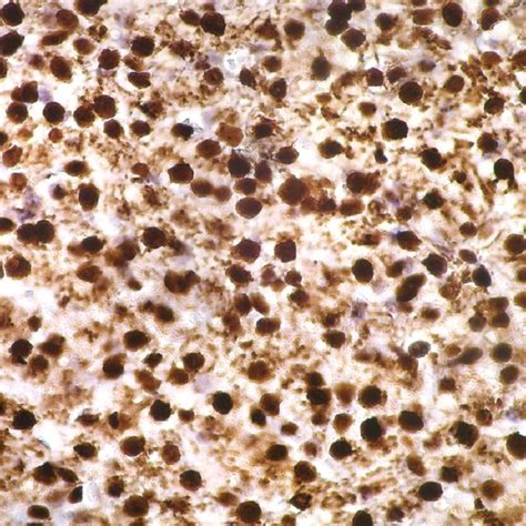 Staging And Grading Of Chronic Hepatitis According To Metavir Download Scientific Diagram