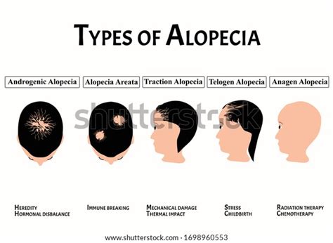 3,732 Alopecia Illustration Images, Stock Photos & Vectors | Shutterstock