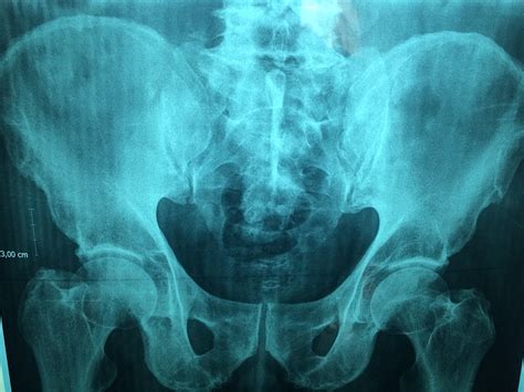 What Is A Pelvis Or Pelvic Xray Two Views