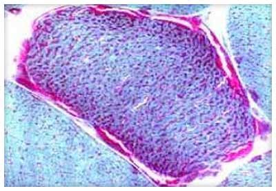 Mitochondrial Myopathy