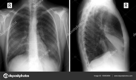 Pneumonia Lateral Chest X Ray