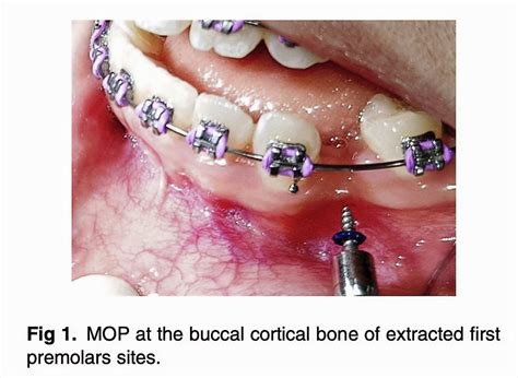 The Osseous Evidence Behind Micro Osteoperforation Technique In